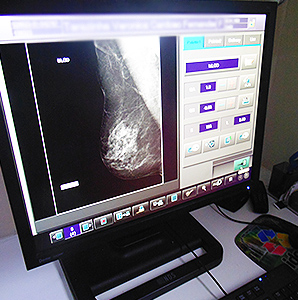 mamografia2