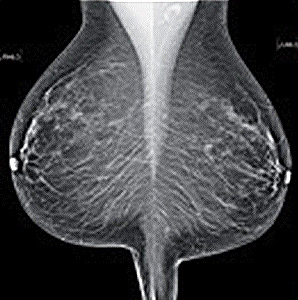 mamografia4